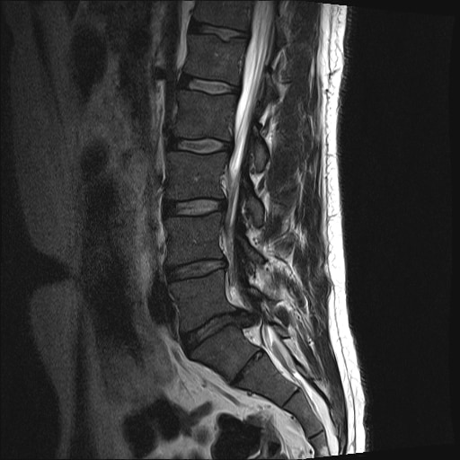 Disc Degeneration - Backspace